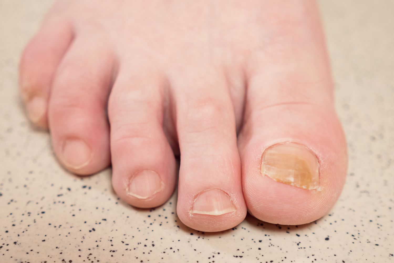 causes-of-thick-toenails