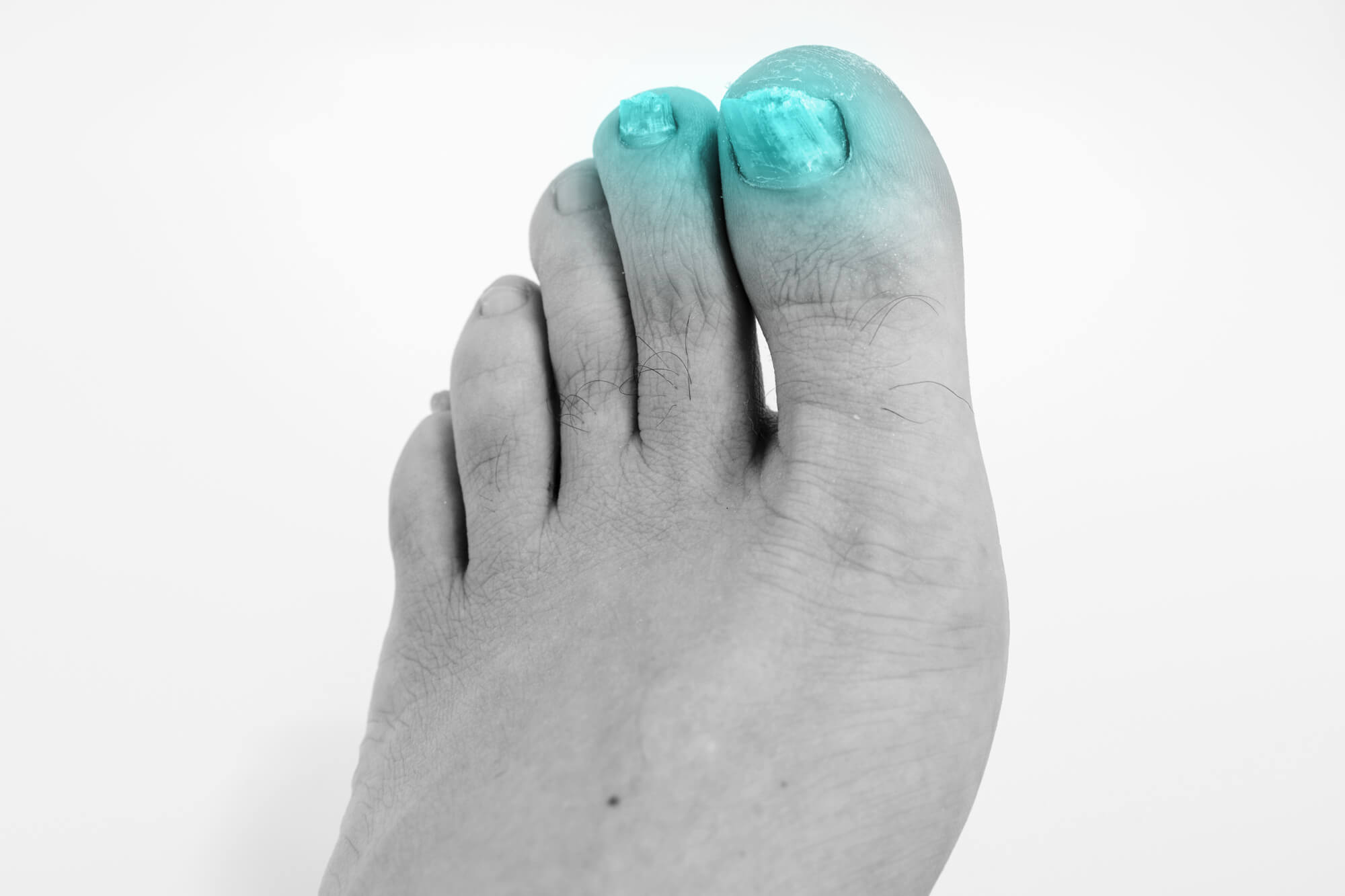 causes-of-thick-toenails